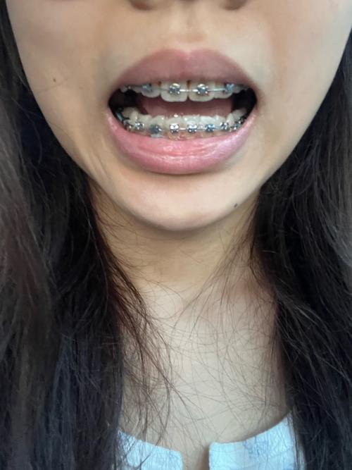 正畸种植钉牙套日记，矫正全程种植钉有哪些关键作用？-图2