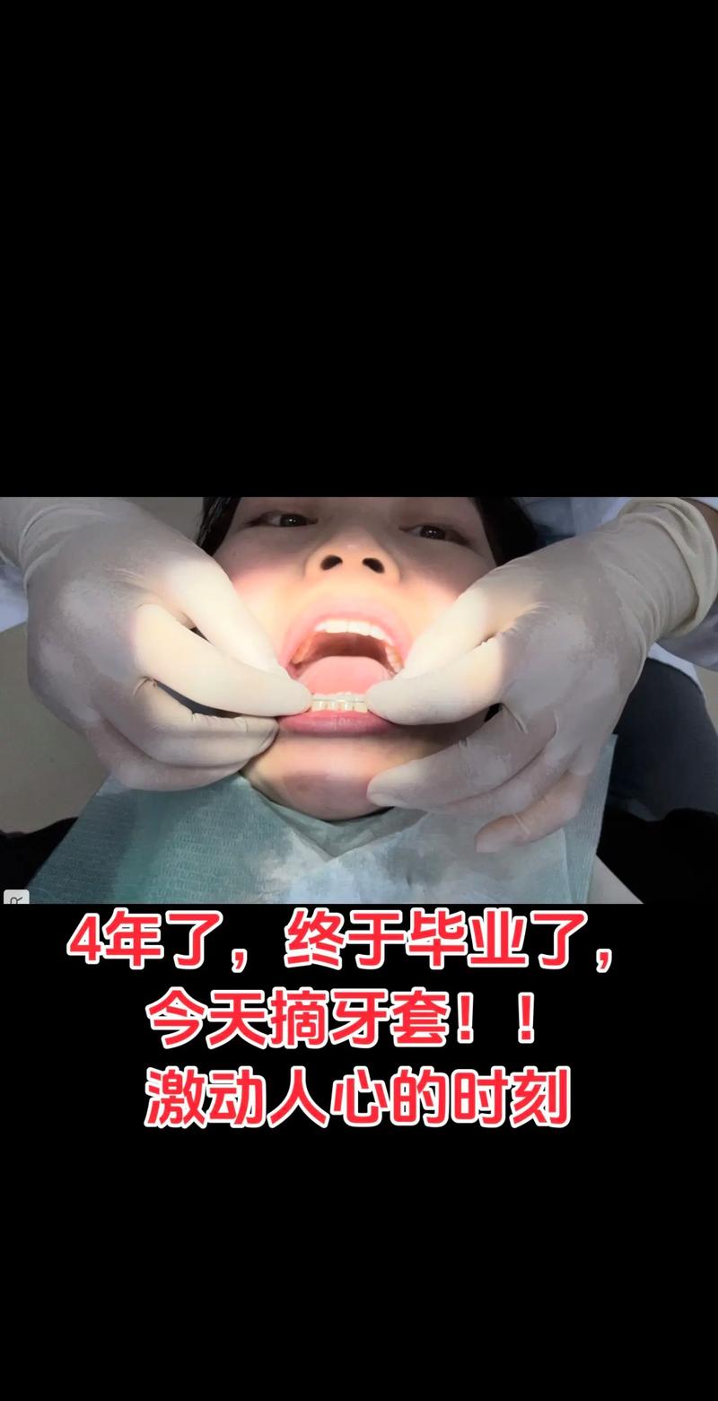 正畸种植钉牙套日记，矫正全程种植钉有哪些关键作用？-图3