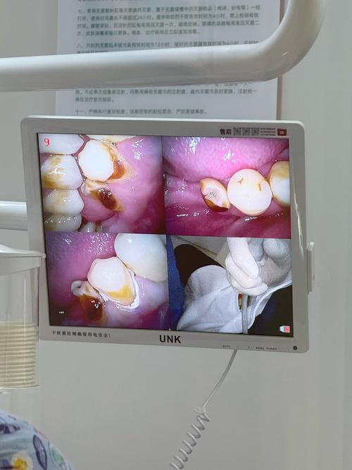 上牙即拔即种效果如何？安全性和适用人群有哪些？-图2