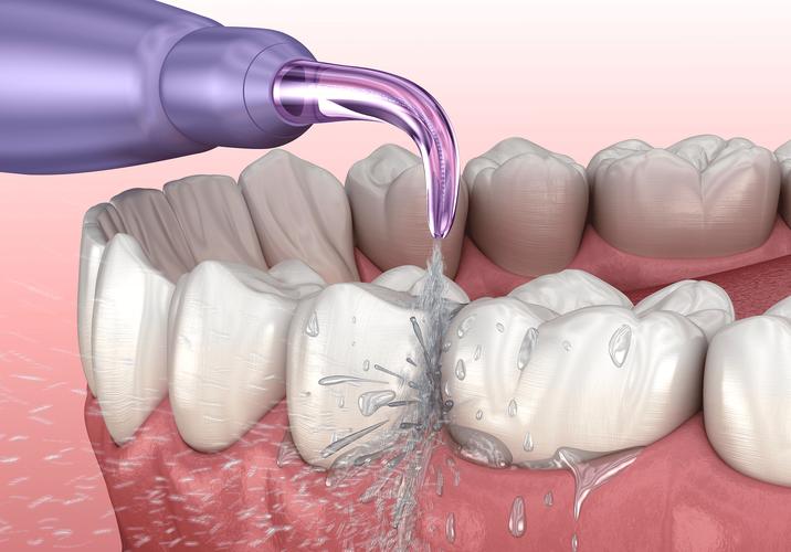 种牙一年后冲洗，是必要维护还是多余操作？-图1