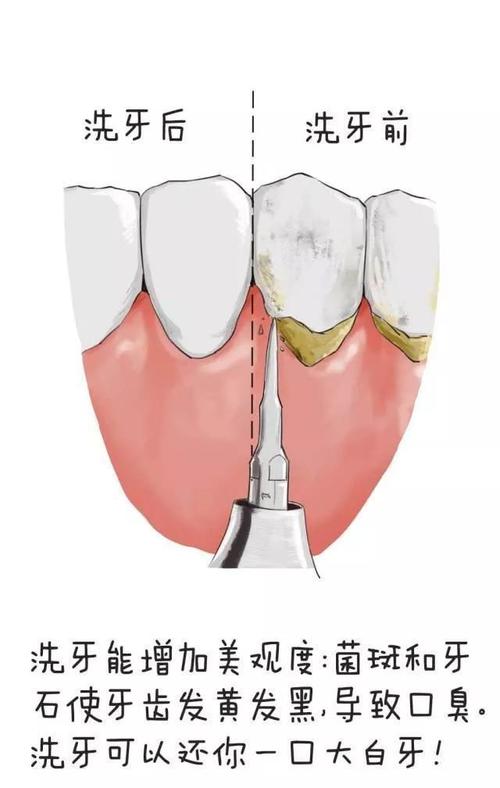 种牙一年后冲洗，是必要维护还是多余操作？-图3