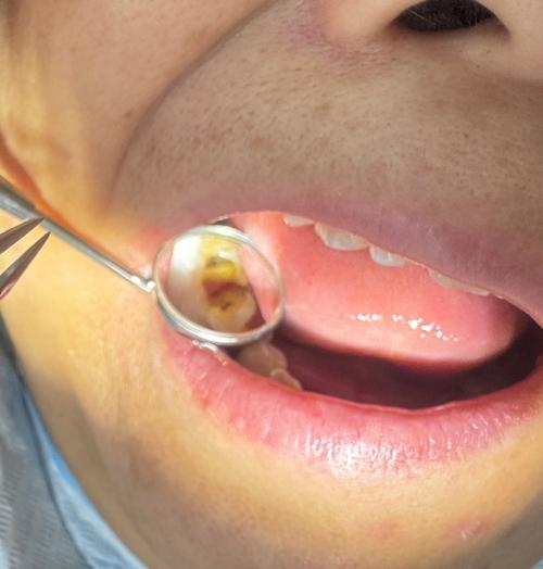 刚正畸后舌头不舒服-图1