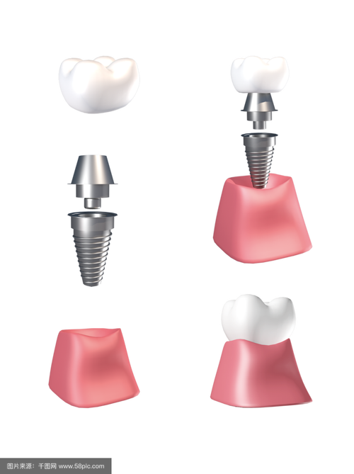 3D技术种牙有哪些优势？效果和安全性如何？-图2