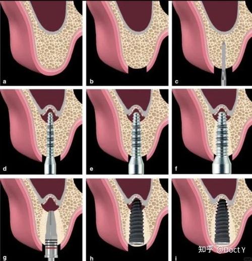 种牙加外提升-图3 种牙加外提升-图3