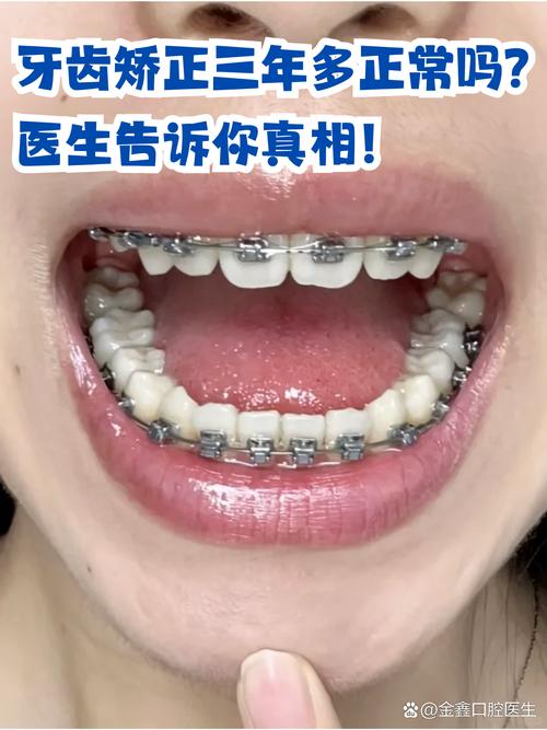 牙齿正畸过程中牙疼-图1