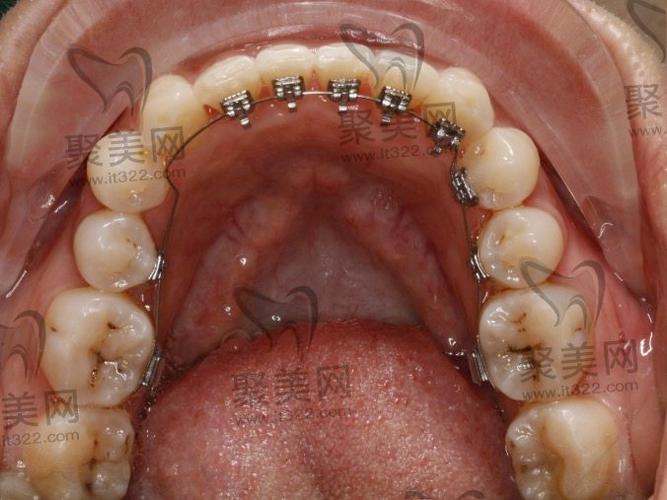 广州舌侧正畸形价格-图3