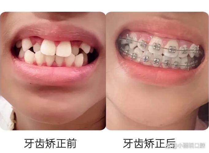 牙列拥挤可以正畸吗-图2