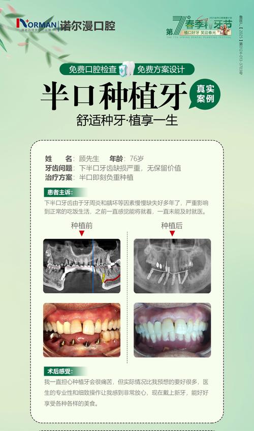 全口种牙帖子-图3 全口种牙帖子-图3