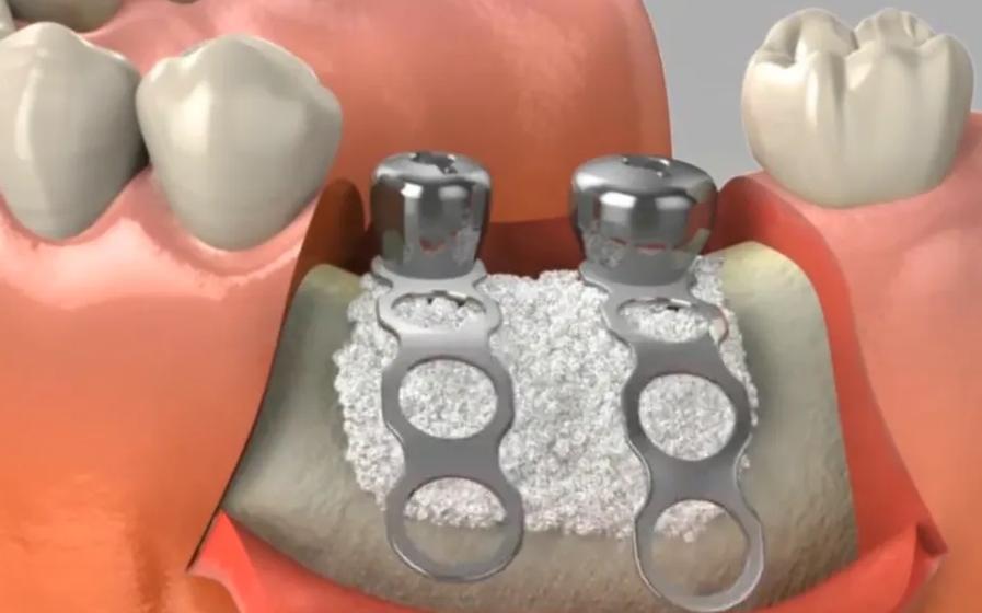 植骨粉后多久能开始正畸治疗？-图3