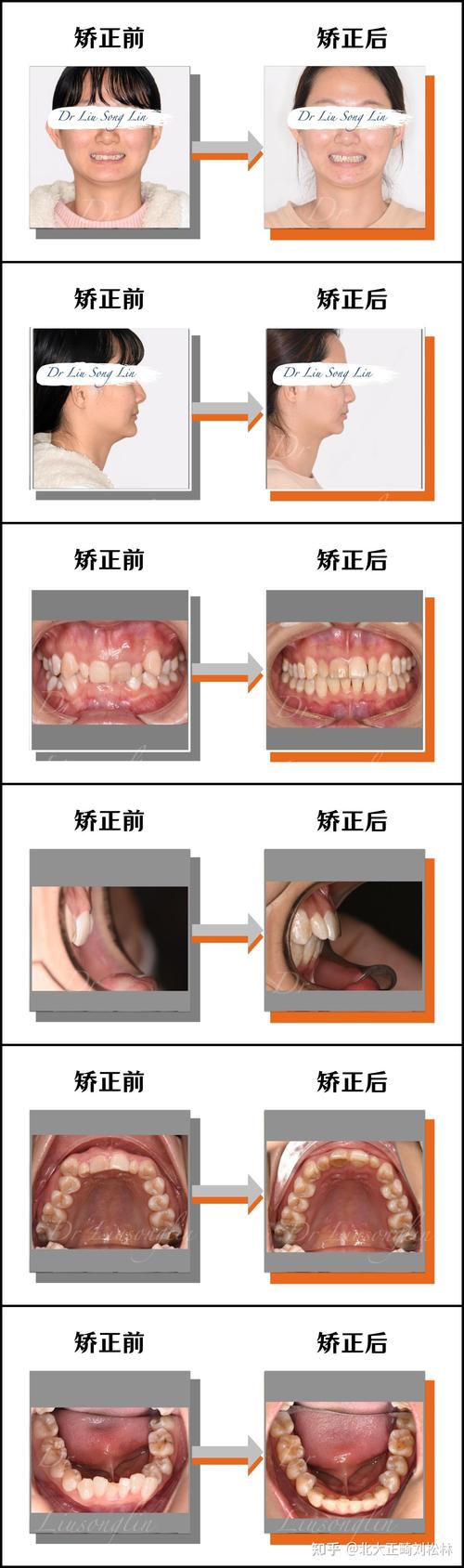 正畸过程中牙齿深覆合，该如何科学矫正？-图2