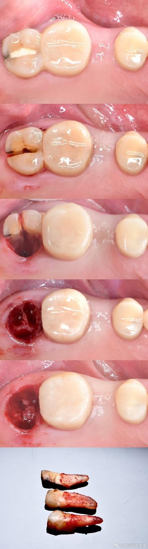 珠海种牙选刘俊？他的技术与口碑如何？-图3