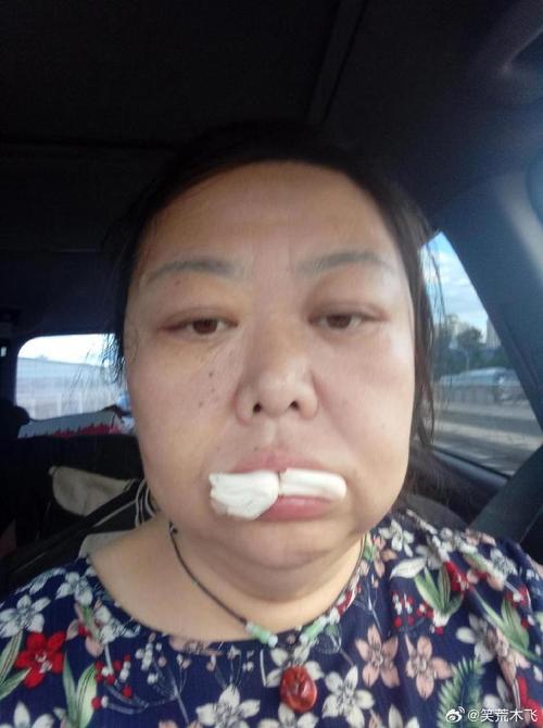 种牙肿的很大-图1