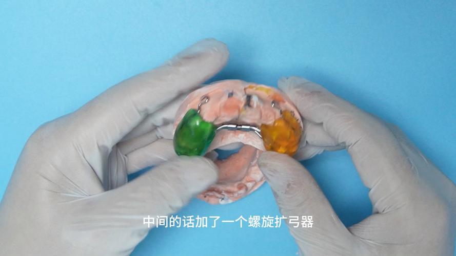 正畸螺旋扩弓器拆解-图2