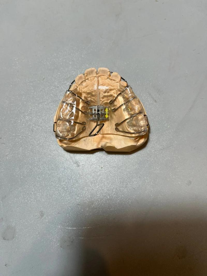 正畸螺旋扩弓器拆解-图3