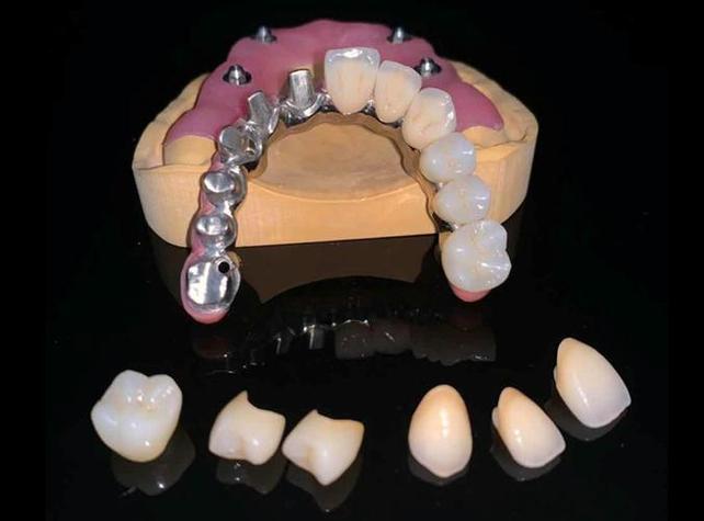 粘结桥和种牙-图3