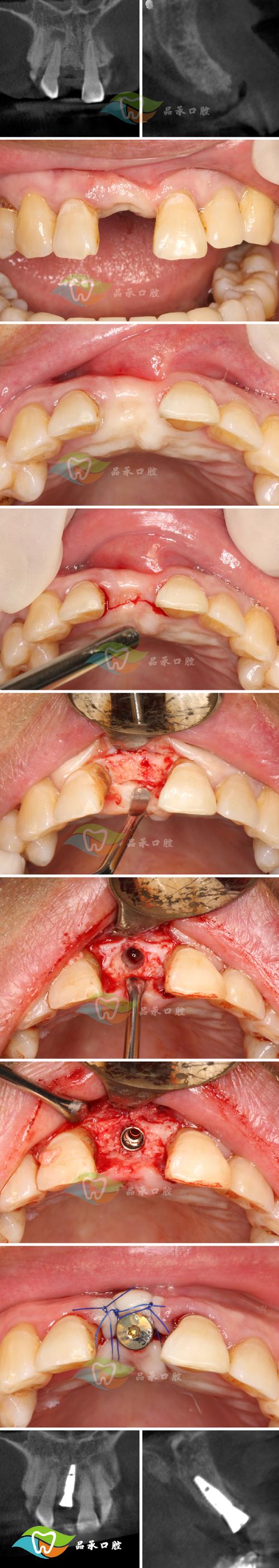 种牙植骨后发烧怎么回事？是正常现象还是需要担心？-图3