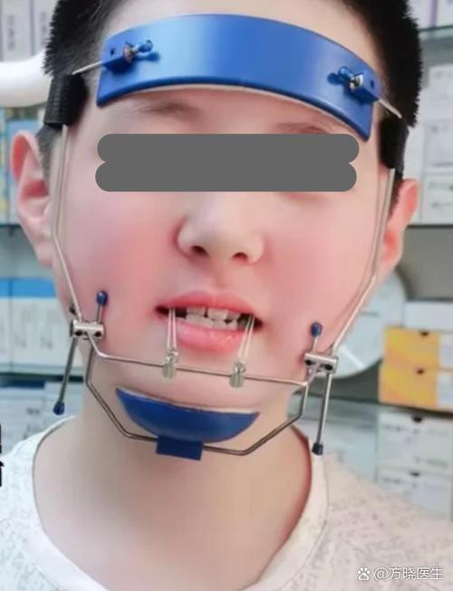 牙科正畸前方牵引器-图1