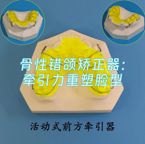 牙科正畸前方牵引器-图3