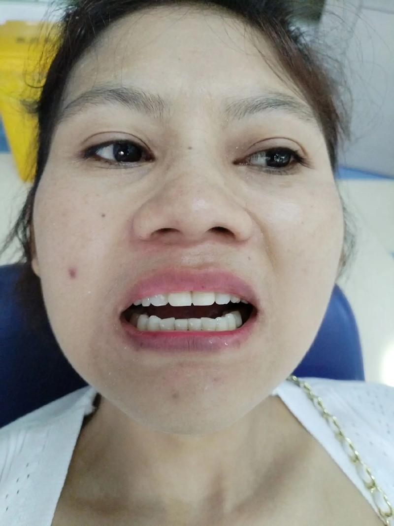 正畸导板晚上戴不戴-图3