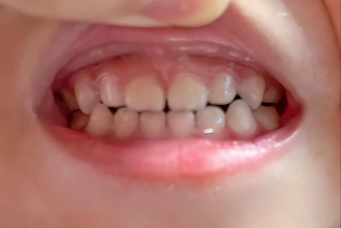 正畸导板晚上戴不戴-图1