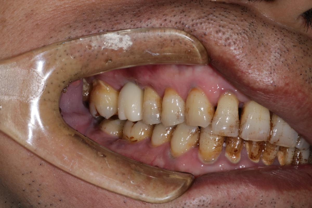 种完牙后抽烟-图1 种完牙后抽烟-图1