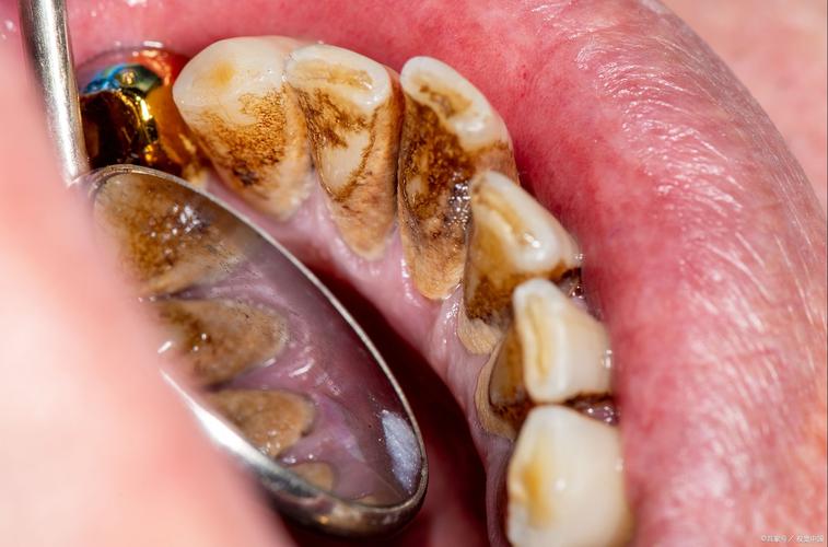 种完牙后抽烟-图3 种完牙后抽烟-图3