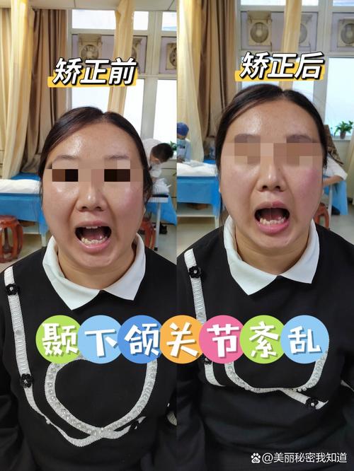 正畸治疗与颞颌关节紊乱，存在怎样的关联？-图1