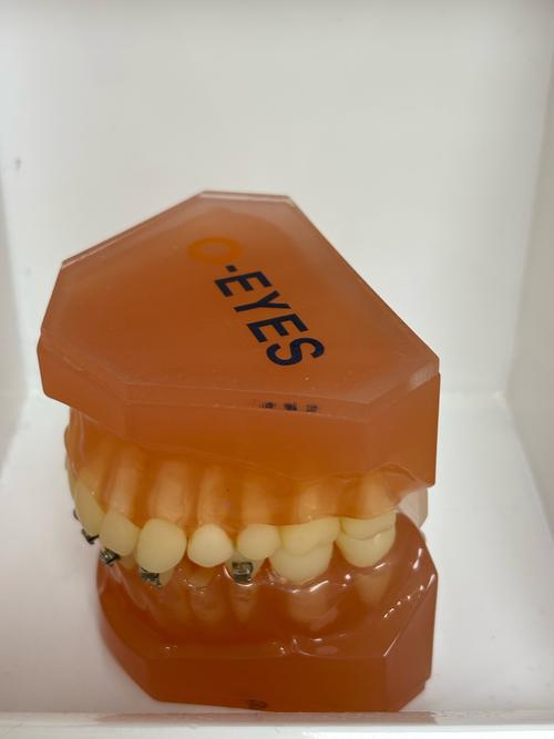正畸粘接剂粘烤瓷牙-图1