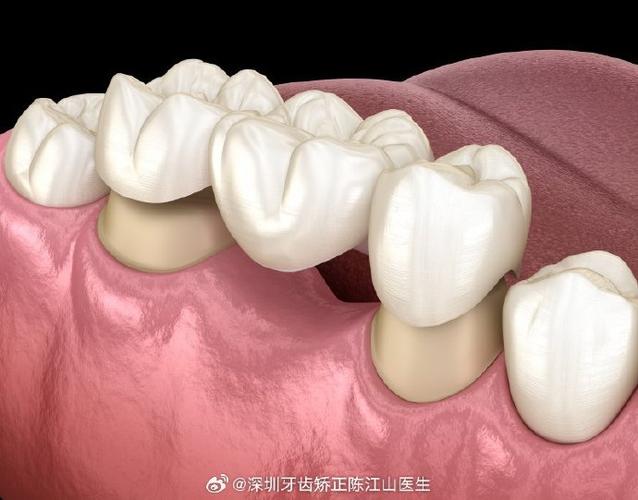 正畸粘接剂粘烤瓷牙-图2