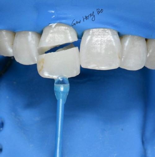 正畸粘接剂粘烤瓷牙-图3