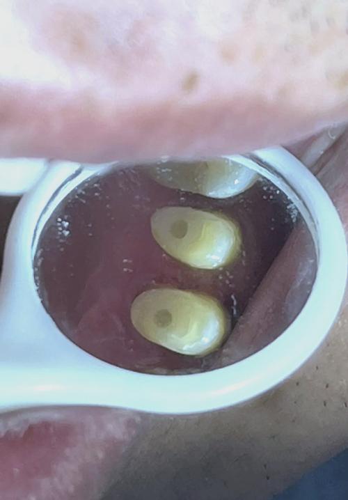 打桩和种牙是一回事吗？-图1