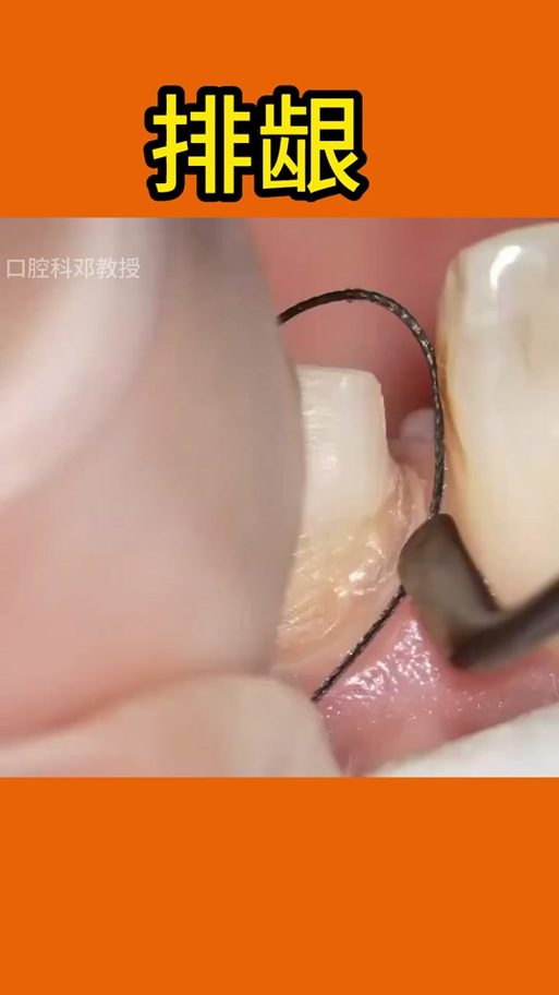 种牙为何需要排龈?这一步骤对种植效果和长期成功率有何关键影响?-图2 种牙为何需要排龈?这一步骤对种植效果和长期成功率有何关键影响?-图2