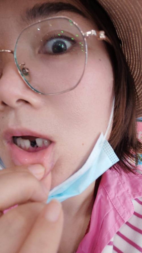 拔牙后即刻种植可行吗？效果与风险如何？-图2