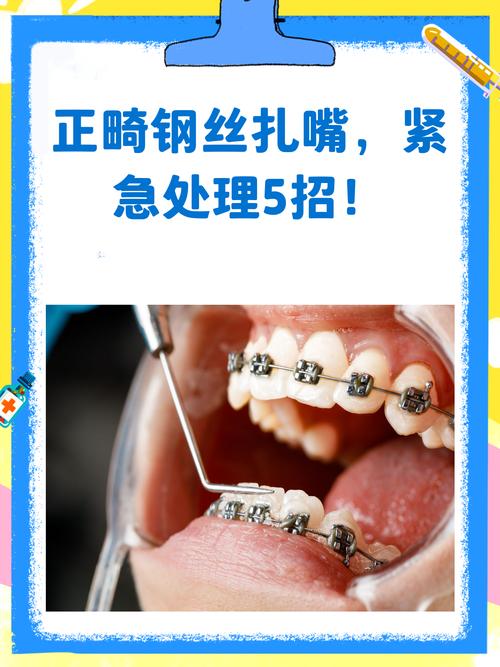 正畸中结扎丝如何正确运用？-图1