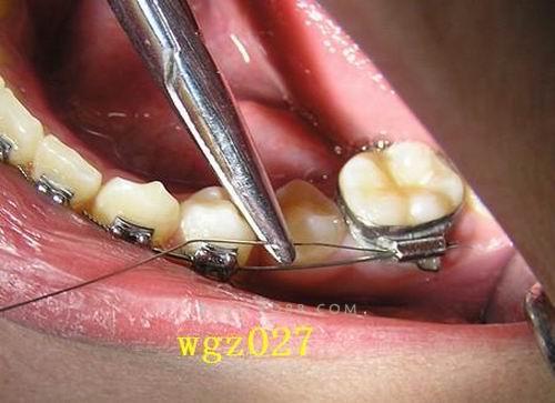 正畸中结扎丝如何正确运用？-图3