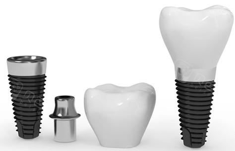 韩国种殖牙体-图1