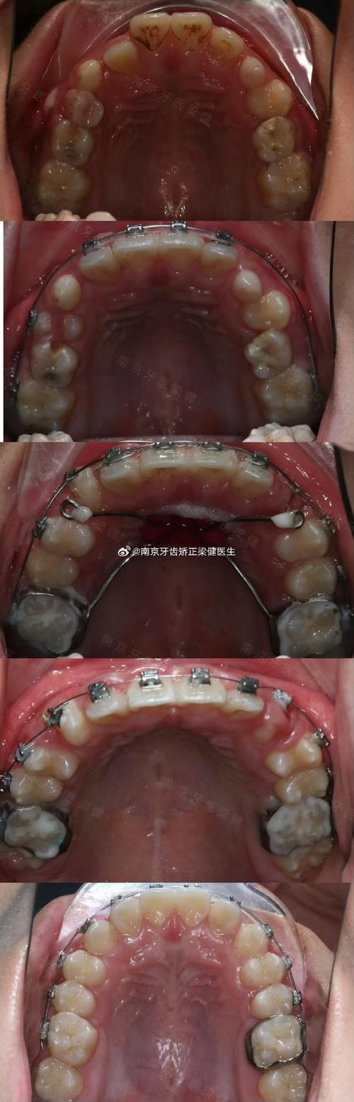 正畸游离埋伏牙牵引的难点与解决方法是什么？-图1