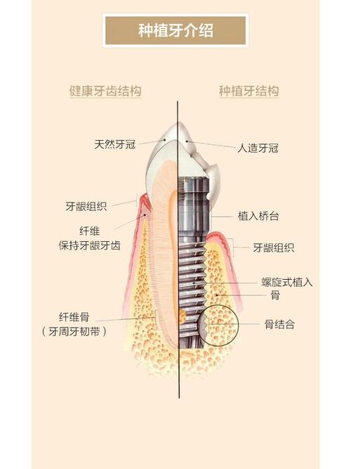 种牙植骨图解详细展示哪些种植修复关键步骤？-图1