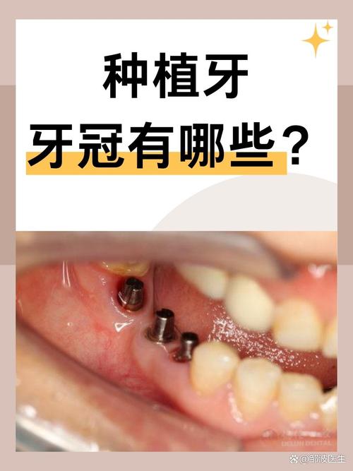 种牙用哪种冠好？材质、价格、美观度如何权衡？-图1