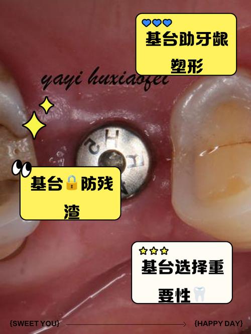 种牙愈合台痛-图1