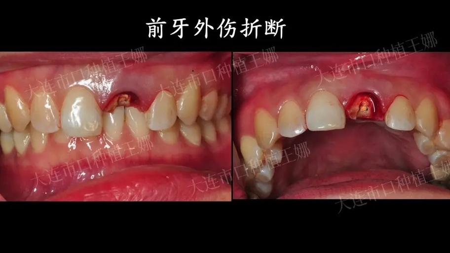 种牙愈合台痛-图3