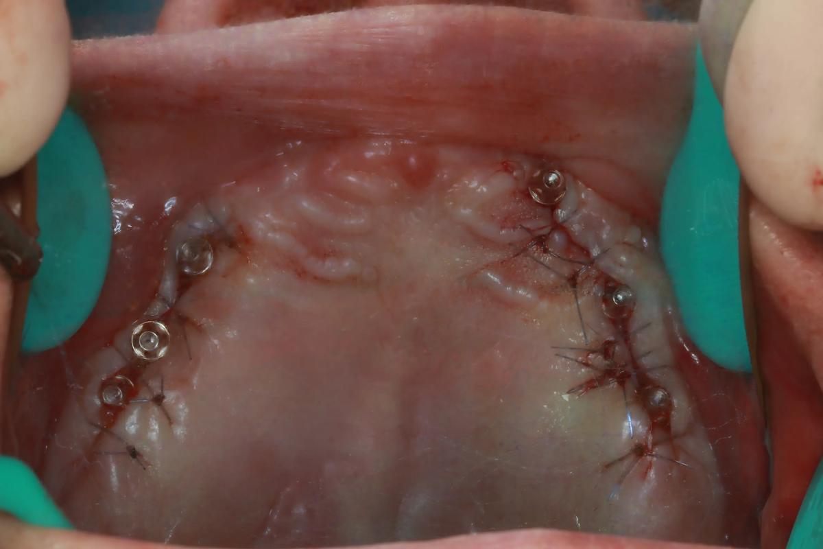 种牙愈合台痛-图2