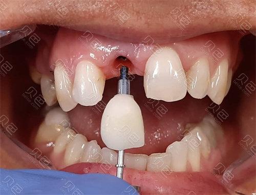 大门牙种牙6-图3 大门牙种牙6-图3