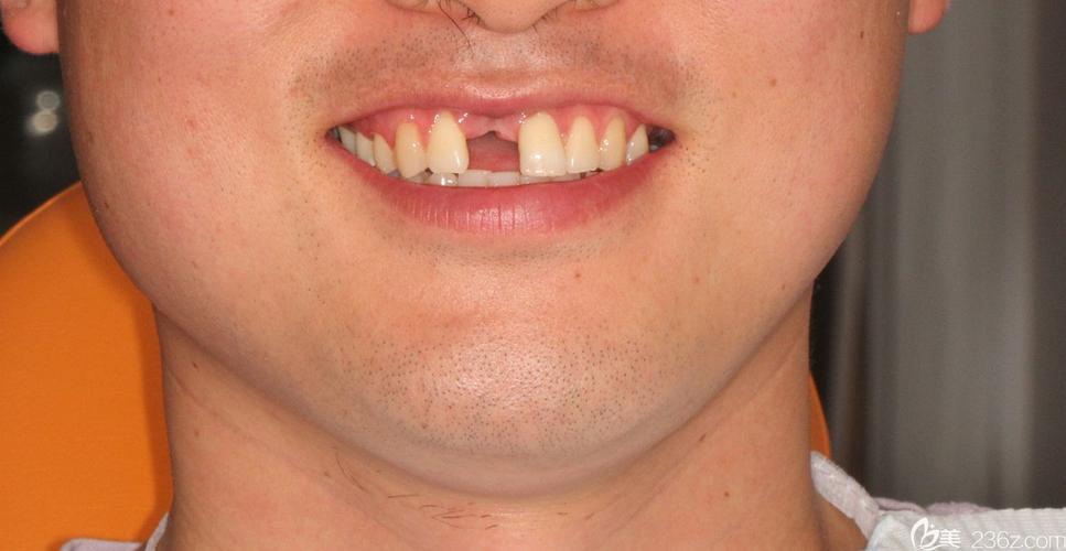 大门牙种牙6-图1 大门牙种牙6-图1