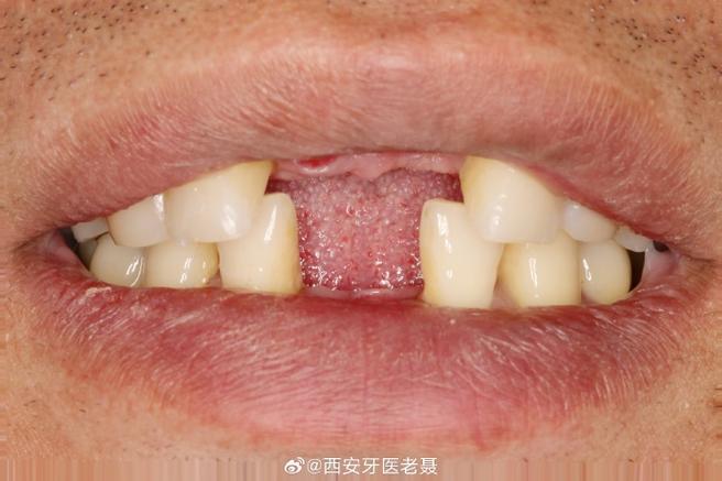 大门牙种牙6-图2 大门牙种牙6-图2