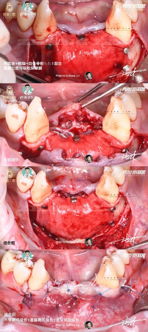 种牙内提手术-图2