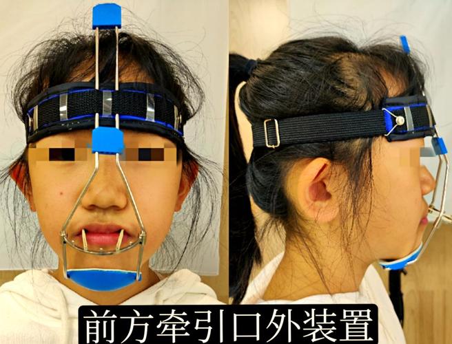 口外正畸牵引器图片能展示哪些关键结构？-图1