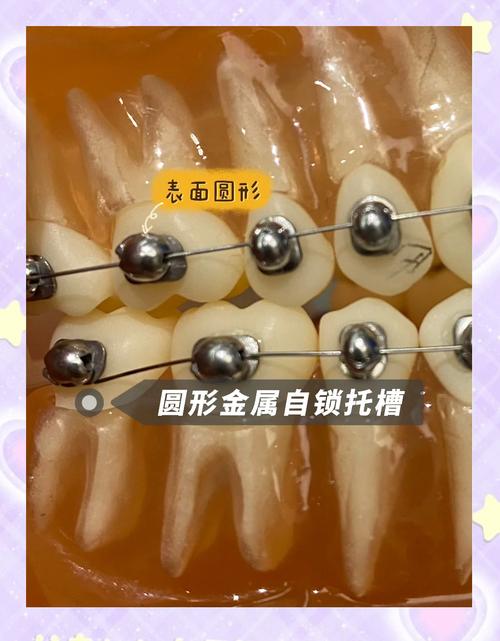 普特正畸托槽好不好？效果安全值得信赖吗？-图3