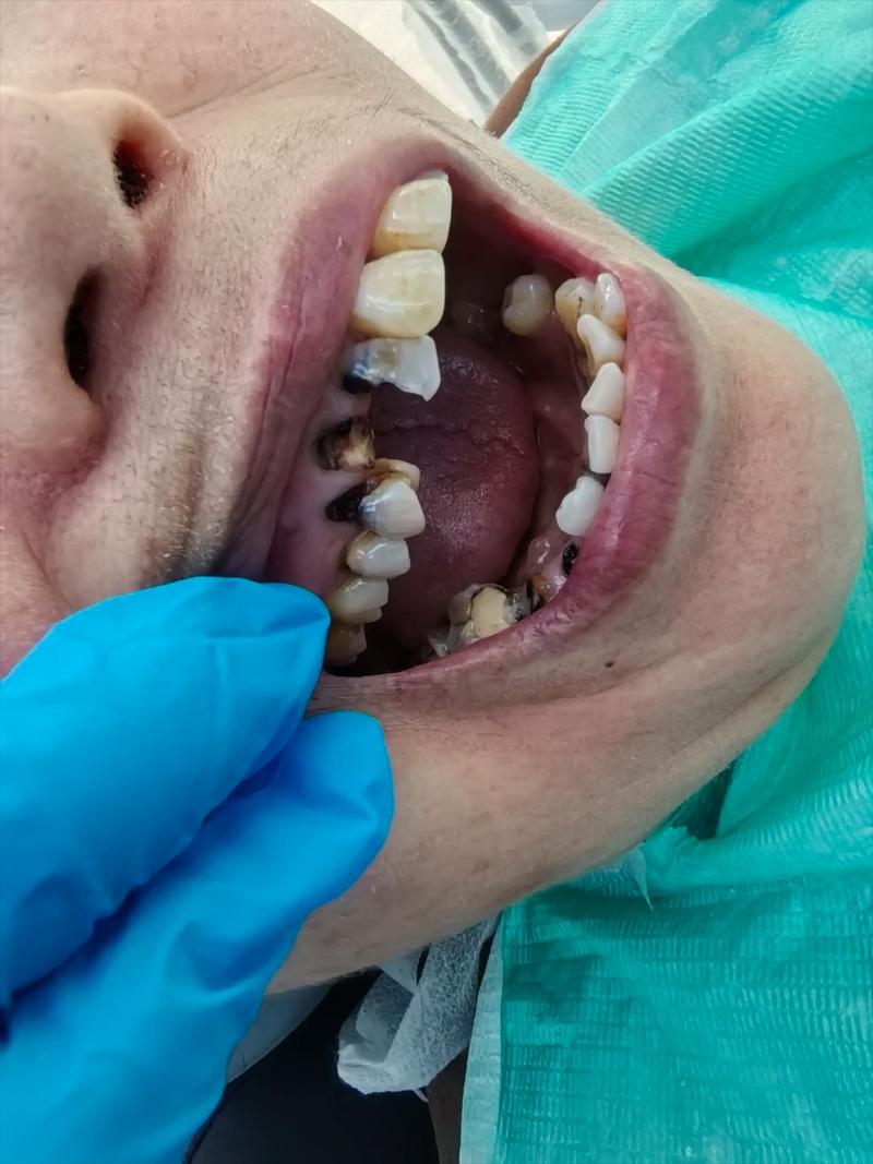 种牙后焦虑怎么办?原因分析与缓解指南-图1 种牙后焦虑怎么办?原因分析与缓解指南-图1