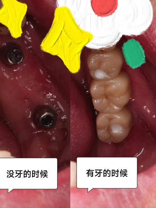 种牙后焦虑怎么办?原因分析与缓解指南-图2 种牙后焦虑怎么办?原因分析与缓解指南-图2